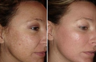 peremajaan kulit wajah laser sebelum dan selepas gambar